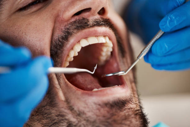 Best Emergency Dental Care for Broken or Chipped Teeth in Lloyd Harbor, NY